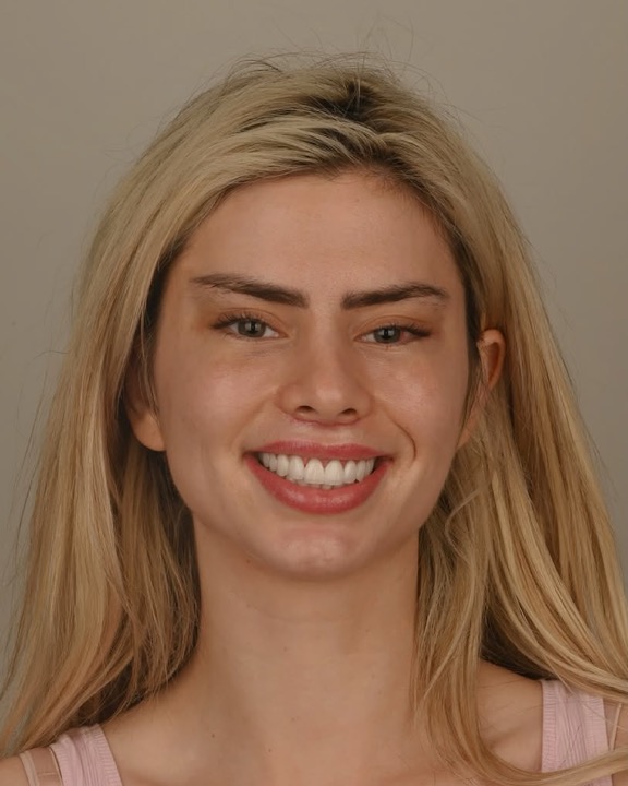 Gummy Smile tedavisinin ardından laminate veneer ve diş beyazlatma uyguladık. Yeni gülüş tasarımı Amerika Birleşik Devletleri’ne 🇺🇸 gidiyor.
——————
After Gummy Smile treatment we applied laminate veneers and teeth whitening. The new Smile design goes to United States🇺🇸
Her tedavinin süreci ve sonucu kişiden kişiye değişebilir. Tedavi öncesinde hekiminizden detaylı bilgi almanız önerilir.
#DişAnalizi #Ortodonti #AğızVeDişSağlığı #DişHekimi #DişDeğerlendirmesi #LeodentDentalClinic