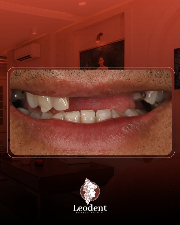 Laminate Veneerler, Beyazlatma, Zirkonyum Kronlar > Yeni gülüş tasarımı Dubai’ye 🇦🇪 gidiyor.
——————
İmplants, Laminate Veneers, Bleaching, Zircon Crowns > A New smile design goes to Dubai 🇦🇪
Her tedavinin süreci ve sonucu kişiden kişiye değişebilir. Tedavi öncesinde hekiminizden detaylı bilgi almanız önerilir.
#DişAnalizi #Ortodonti #AğızVeDişSağlığı #DişHekimi #DişDeğerlendirmesi #LeodentDentalClinic